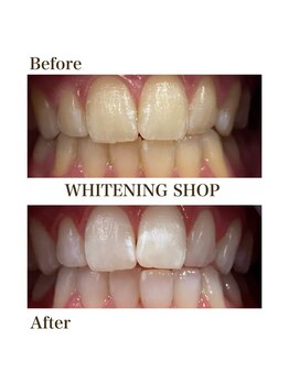 ホワイトニングショップ 恵比寿店/【Before After】フリーパス