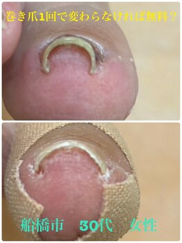 巻き爪じゅん 千葉駅前店/巻き爪初回で変わらなければ無料