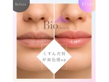 バイオビューティー 神戸本店(Bio Beauty)/プランプピンク症例
