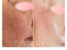 ストーリー(STORY)/ハーブピーリング専門店STORY