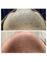 アンジェリーナ/ヒゲ脱毛5回照射