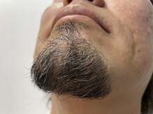 リアンジュ/肌質も毛質も問わない最新脱毛