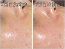 おうちサロン ミキ/しみ改善