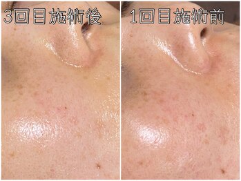 おうちサロン ミキ/しみ改善