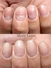 マリーロール 梅田店(Marie Laure)/自爪育成/深爪矯正/ネイルケア