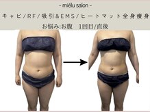 ミエル(mielu)/全身痩身　お腹　