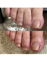 リリ(lili)/トータルフットケア1回目