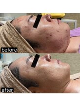 スプレミア(spuremia)/ニキビ症例