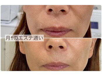 ネージュ(Neige)/月に1度のエステ通い