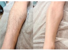 ピヴァーチェ(Pivace)/痛み最小限でツルスベ肌へ♪