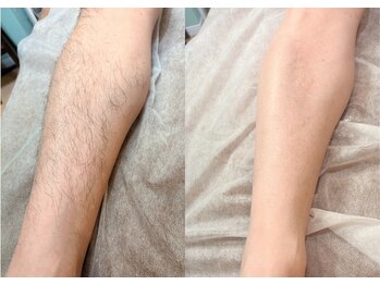 ピヴァーチェ(Pivace)/痛み最小限でツルスベ肌へ♪