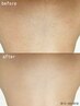 《女性/脱毛人気No.1☆》カウンセリング付◎全身脱毛 (顔VIOあり) ¥12100