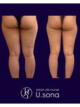 小顔・脂肪コントロール専門 salon de nurse U.sona～松本店～/【痩身】太もも脂肪分解症例