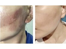 モガナ(mogana)/炭酸パック/エナジーケア