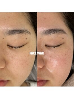 ミィ(mi)/HBL+全顔WAX+鎮静パック付き