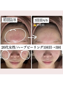 ホワイトアクア 福岡天神店(WHITE AQUA)/20代女性ハーブピーリング