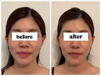 キプラ 福津店(KIPURA)/小顔矯正1回目