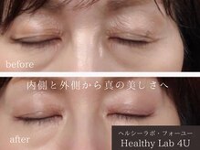 ヘルスラボフォーユー(Health Labo4U)/ニキビだけじゃない！