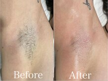 ジョエルワックス 沖縄那覇店(JOELLE WAX)/ツルツル脇を手に入れたい方！★