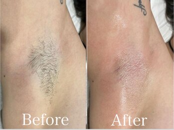 ジョエルワックス 沖縄那覇店(JOELLE WAX)/ツルツル脇を手に入れたい方！★