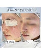 リアン(Lien)/【症例】毛穴ケアコース