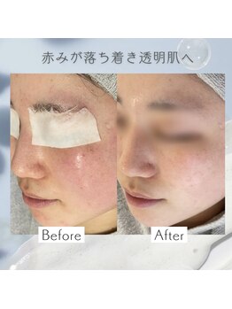 リアン(Lien)/【症例】毛穴ケアコース