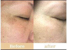 ロミロミリレイス(romilomi)/シリカパック【エステ/武蔵境】