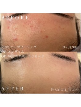 フローレ 平針店(Flore)/繰り返すニキビケアに