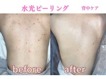 ミレット(Miretto)/背中のニキビ・跡に◎水光ピール