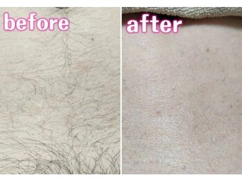 アロマソルト(Aroma salt)/ブラジリアンワックス脱毛