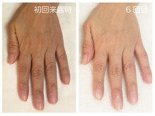 キレイテ 福岡天神店/50代/6回目【大名ハンドケア】