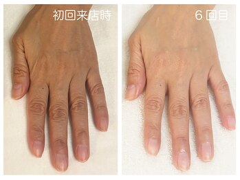 キレイテ 福岡天神店/50代/6回目【大名ハンドケア】