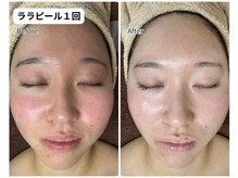 レミーラ(Remira)の雰囲気（★正規代理店【ララピール】人気No. 1の肌育メニュー）