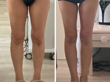 ナースのロミリンパ/足の浮腫みにもハイパーナイフ７