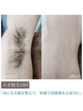 ティンクル サロン(Twinkle salon)/脇脱毛で清潔感アップ