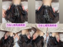 るあん/うなじ脱毛Before＆After