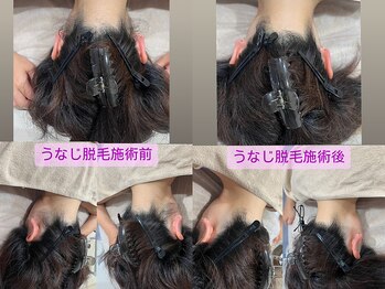 るあん/うなじ脱毛Before&After