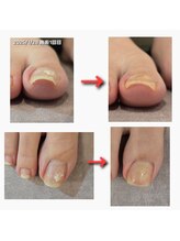 クレセント アイアンドネイル 今泉店(Crescent)/巻き爪ケア