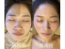 エイミー(Amy)/1週間置きコルギ２回の効果！