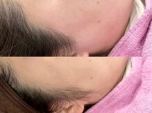 ルチア(Lucia)/フェイスワックスで艶肌美人へ