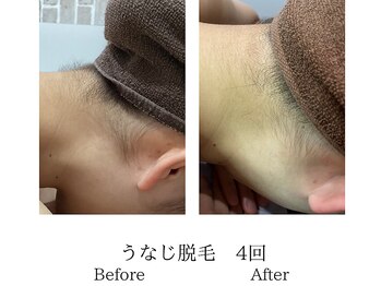 ミーシェ(Meshie)/襟足脱毛　施術前後