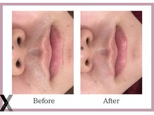 クロス(Xcross)/フェイスワックス【毛穴/渋谷】