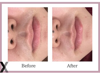 クロス(Xcross)/フェイスワックス【毛穴/渋谷】