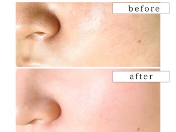 ビューティズムラウンジ(Beautism Lounge)/毛穴ケアフェイシャル