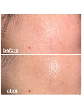 ミニョン(mignon)/夏のダメージ大丈夫ですか？