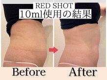 エトワール(etoile)/天王寺あべの脂肪分解10cc