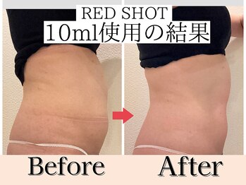 エトワール(etoile)/天王寺あべの脂肪分解10cc