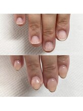 リーセンス(Re'ense)/深爪矯正