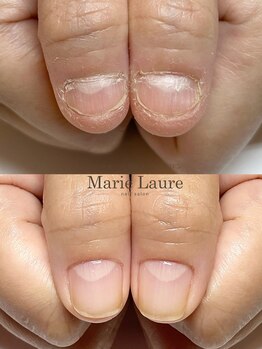マリーロール 梅田店(Marie Laure)/自爪育成/深爪矯正/ネイルケア
