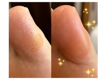 アベビー(Abeby)/親指のタコ